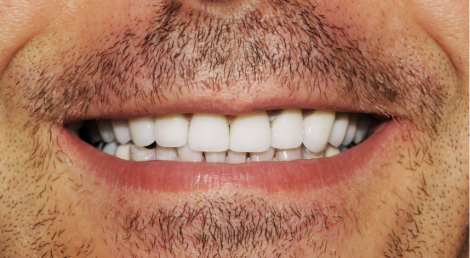 After — complete full mouth smile restoration with implants