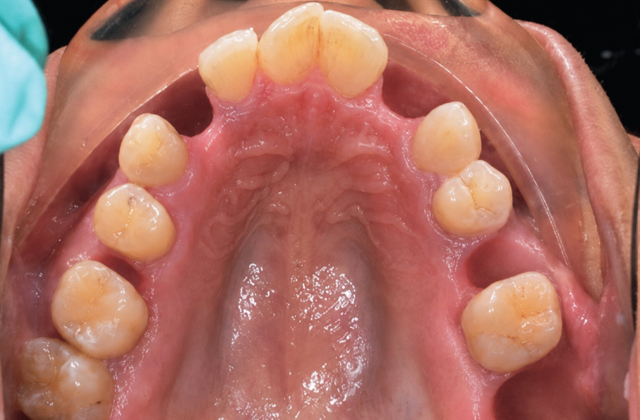 Before — lower arch teeth restored with Full-Mouth implants at Downtown Dental