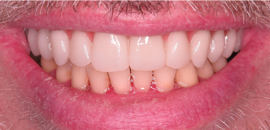 After — fixed, natural-looking upper arch Full-Mouth smile at Downtown Dental