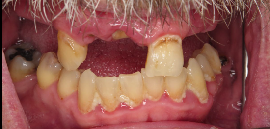 Before — upper arch Full-Mouth implant restoration at Downtown Dental