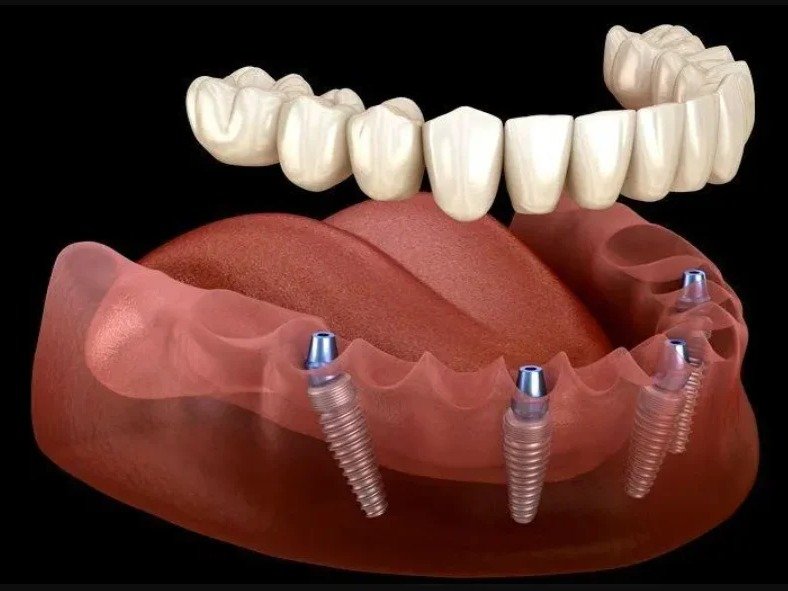 Full arch mouth restoration