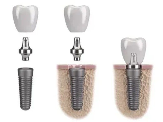 Dental implant
