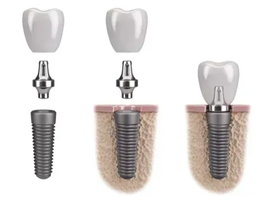 Dental implant